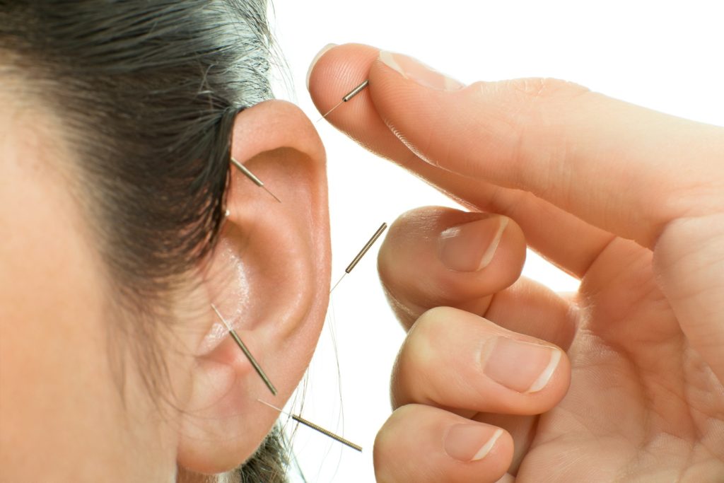 ear acupuncture on Long Island