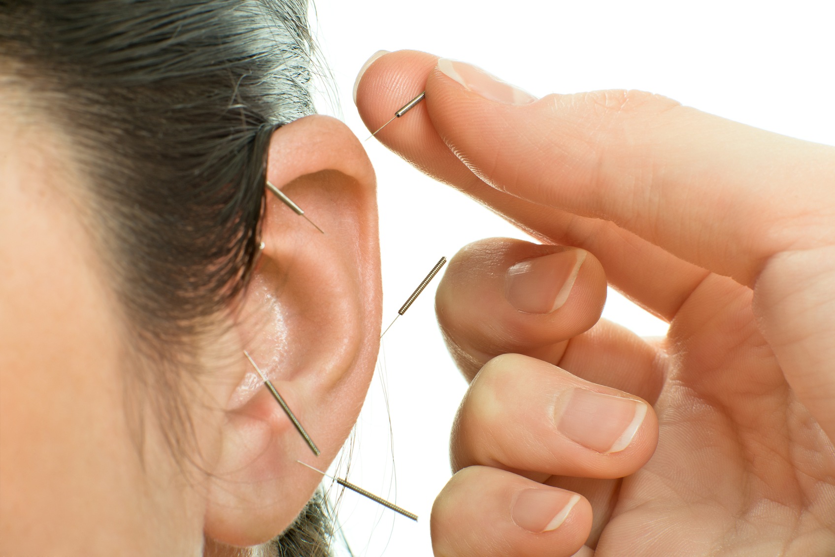 ear acupuncture on Long Island